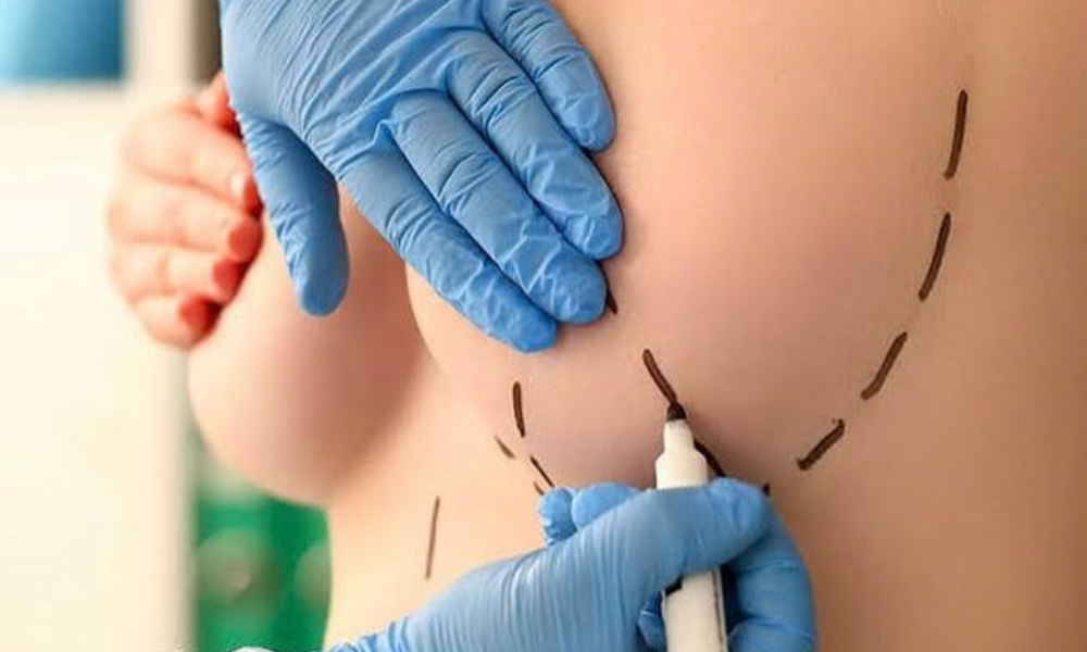 Chirurgia del seno: studio multicentrico Italia-Grecia apre nuove prospettive per il lipofilling Chirurgia del seno: studio multicentrico Italia-Grecia apre nuove prospettive per il lipofilling